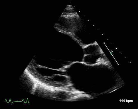 systolic heart failure echo